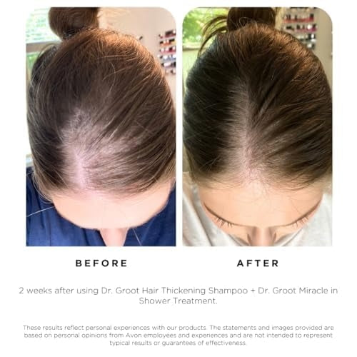 Dr. Groot Thickening Serum, Shampoo, Conditioner, and Scalp Treatment Set for Hair Loss – Clinical Results with Biotin and Rosemary for Hair Thinning, Shedding, Scalp Repair and Treatment
